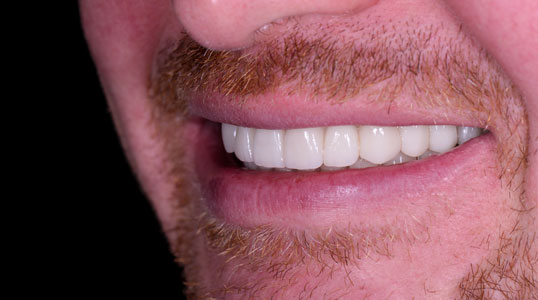 after dental implants